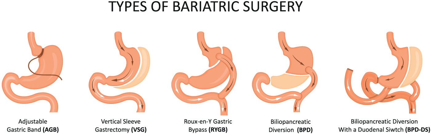 Revisional Bariatric Surgery Surgical WeightMatters