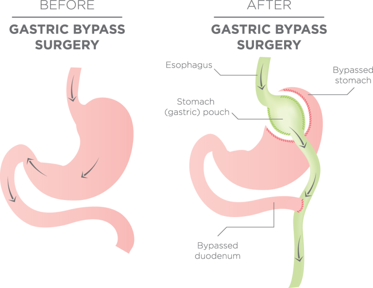 Gastric Bypass - Surgical WeightMatters