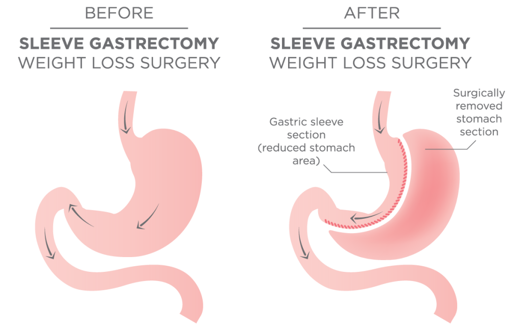 Diagram showing the reduced stomach area following gastric sleeve surgery.